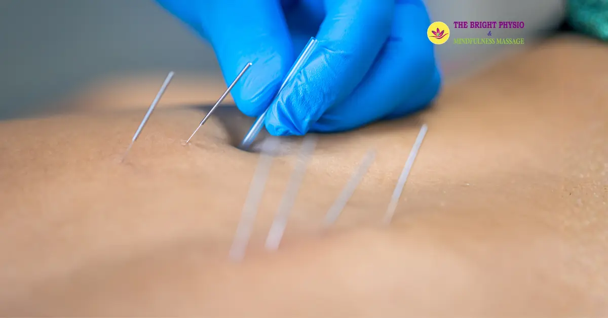 Is Dry Needling Safe? Risks, Side Effects & What to Expect Answered by a Physiotherapist