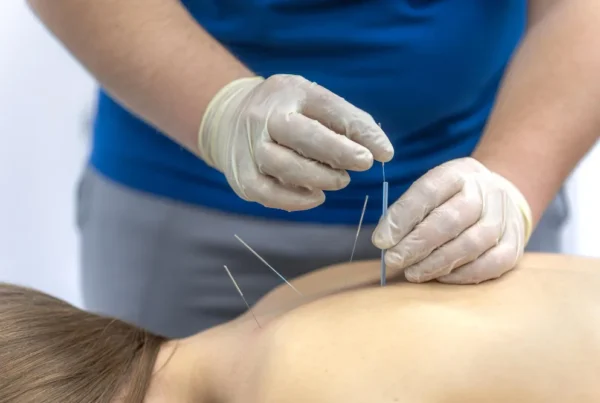 Dry Needling Physiotherapy in beaumont